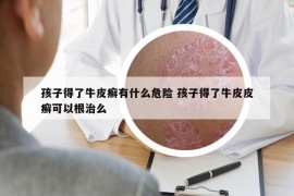 孩子得了牛皮癣有什么危险 孩子得了牛皮皮癣可以根治么