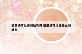 银屑病可以擦润肤乳吗 银屑病可以抹什么润肤剂