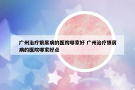 广州治疗银屑病的医院哪家好 广州治疗银屑病的医院哪家好点