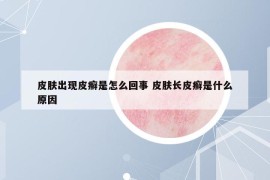 皮肤出现皮癣是怎么回事 皮肤长皮癣是什么原因