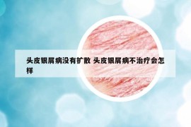 头皮银屑病没有扩散 头皮银屑病不治疗会怎样