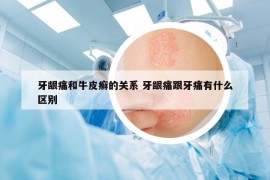 牙龈痛和牛皮癣的关系 牙龈痛跟牙痛有什么区别