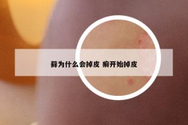 藓为什么会掉皮 癣开始掉皮