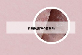 白癜风用308有用吗