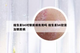 维生素b6对银屑病有用吗 维生素b6软膏治银屑病