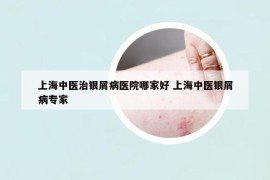 上海中医治银屑病医院哪家好 上海中医银屑病专家