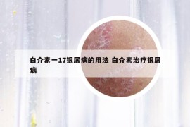 白介素一17银屑病的用法 白介素治疗银屑病