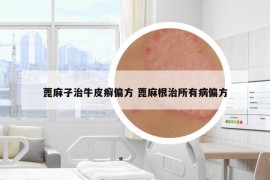 蓖麻子治牛皮癣偏方 蓖麻根治所有病偏方