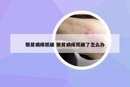 银屑病痒抓破 银屑病痒抓破了怎么办