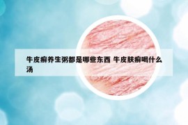 牛皮癣养生粥都是哪些东西 牛皮肤癣喝什么汤