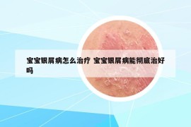 宝宝银屑病怎么治疗 宝宝银屑病能彻底治好吗