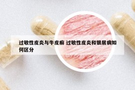 过敏性皮炎与牛皮癣 过敏性皮炎和银屑病如何区分