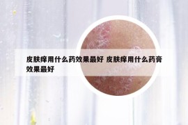 皮肤痒用什么药效果最好 皮肤痒用什么药膏效果最好