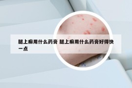 腿上癣用什么药膏 腿上癣用什么药膏好得快一点