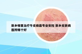 新乡哪里治疗牛皮癣最专业安阳 新乡皮肤病医院哪个好