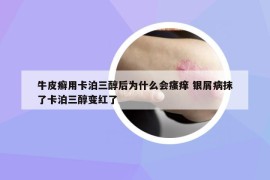 牛皮癣用卡泊三醇后为什么会瘙痒 银屑病抹了卡泊三醇变红了