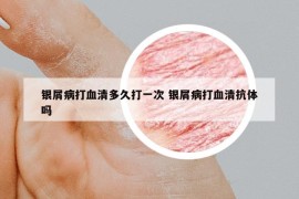 银屑病打血清多久打一次 银屑病打血清抗体吗