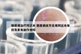 银屑病治疗阿达木 银屑病关节炎用阿达木单抗生素有副作用吗