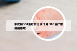 牛皮癣308治疗有无副作用 308治疗银屑病原理