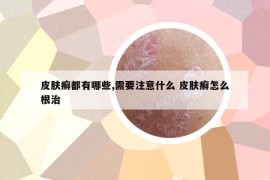 皮肤癣都有哪些,需要注意什么 皮肤癣怎么根治