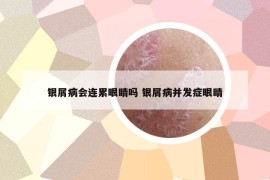 银屑病会连累眼睛吗 银屑病并发症眼睛