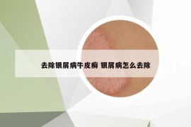 去除银屑病牛皮癣 银屑病怎么去除