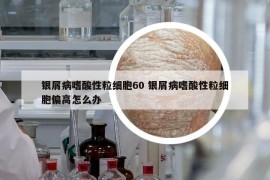 银屑病嗜酸性粒细胞60 银屑病嗜酸性粒细胞偏高怎么办