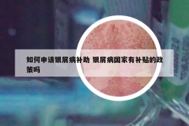 如何申请银屑病补助 银屑病国家有补贴的政策吗