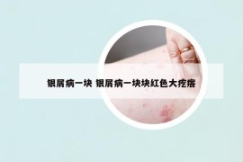 银屑病一块 银屑病一块块红色大疙瘩