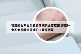 肾囊肿会不会引起银屑病的主要原因 肾囊肿会不会引起银屑病的主要原因是