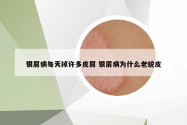 银屑病每天掉许多皮屑 银屑病为什么老蜕皮