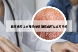 银屑病可以吃可乐鸡翅 银屑病可以吃可乐吗