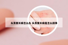 头发里长癣怎么办 头发里长癣是怎么回事