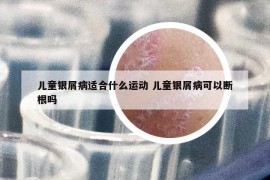 儿童银屑病适合什么运动 儿童银屑病可以断根吗