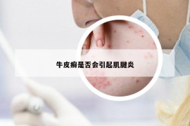 牛皮癣是否会引起肌腱炎