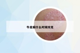 牛皮癣什么时候攻克