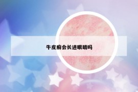 牛皮癣会长进眼睛吗