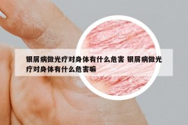 银屑病做光疗对身体有什么危害 银屑病做光疗对身体有什么危害嘛