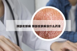 颈部皮肤癣 颈部皮肤癣涂什么药膏