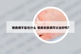 银癣病不能吃什么 银癣皮肤病可以治好吗?