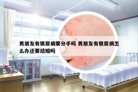 男朋友有银屑病要分手吗 男朋友有银屑病怎么办还要结婚吗