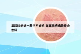 掌跖脓疱病一辈子不好吗 掌跖脓疱病最终会怎样