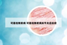 可善挺银屑病 可善挺银屑病关节炎适应症