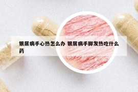 银屑病手心热怎么办 银屑病手脚发热吃什么药