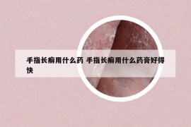 手指长癣用什么药 手指长癣用什么药膏好得快