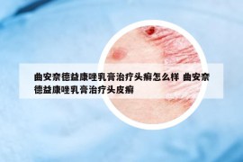 曲安奈德益康唑乳膏治疗头癣怎么样 曲安奈德益康唑乳膏治疗头皮癣