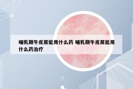 哺乳期牛皮屑能用什么药 哺乳期牛皮屑能用什么药治疗