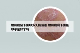 银屑病留下黑印多久能消退 银屑病剩下黑色印子是好了吗