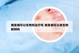 银屑病可以生物剂治疗吗 银屑病可以用生物制剂吗