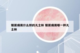 银屑病用什么样的凡士林 银屑病用哪一种凡士林